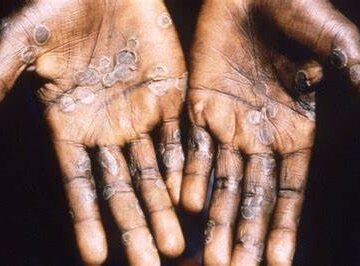 Ghana confirms six new Mpox cases, total rises to 91