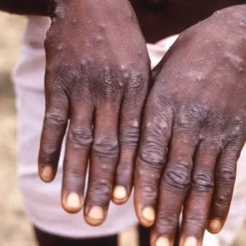 Ghana Confirms 735 Mpox Cases as 22 New Infections Emerge