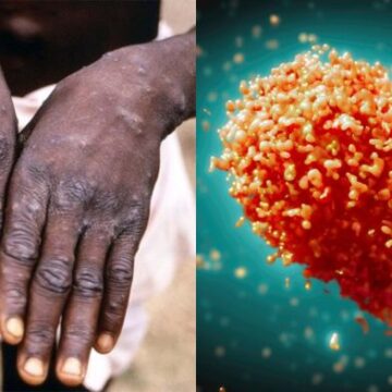 Ghana Records 36 New Mpox Cases; National Tally Hits 657