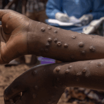 Ghana Health Service Confirms 11 New Mpox Cases